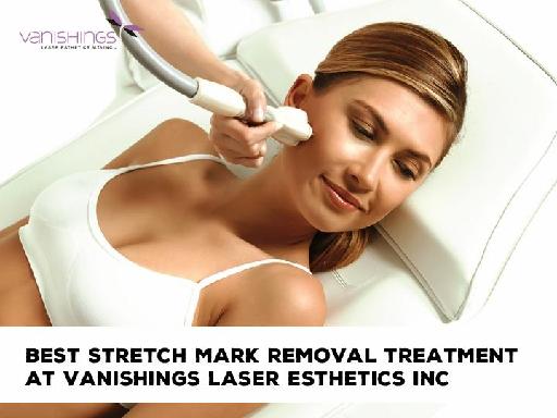 Best Stretch Mark Removal Treatment