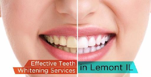 Effective Teeth Whitening Services in Lemont IL