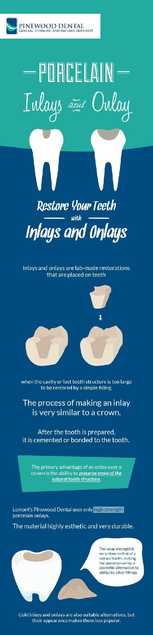 Restore Your Teeth with Inlays and Onlays by Pinewood Dental